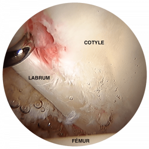 arthroscopie de hanche docteur jacquel