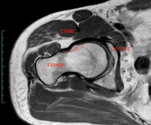 conflit de hanche lesion labrum