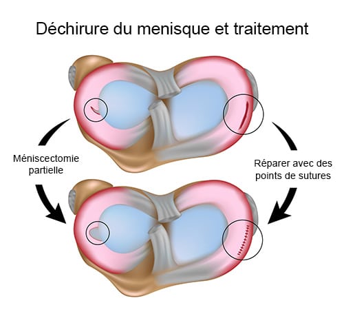 menisque docteur jacquel