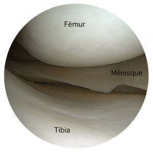 menisque vue arthroscopique docteur jacquel