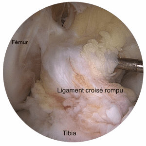 rupture ligament croisee docteur jacquel