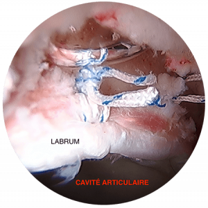 suture labrum docteur jacquel