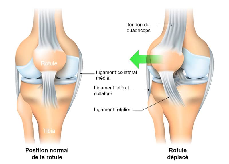 Luxation et instabilité de la rotule