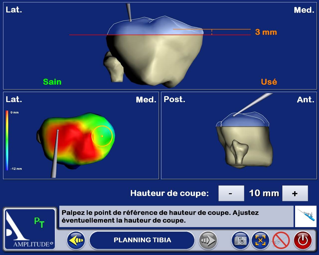 planing tibia 1