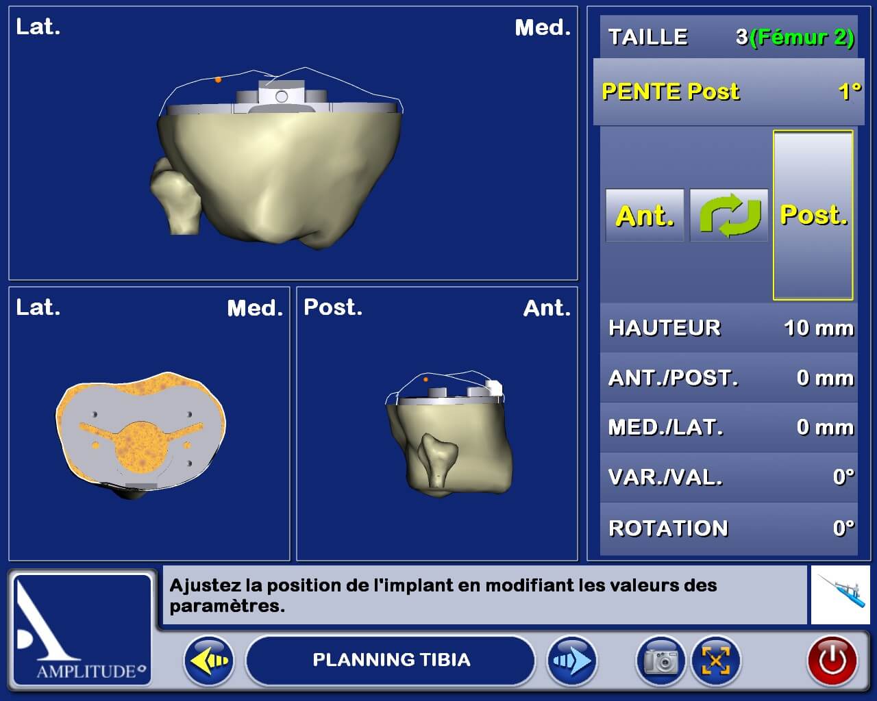 planing tibia 2