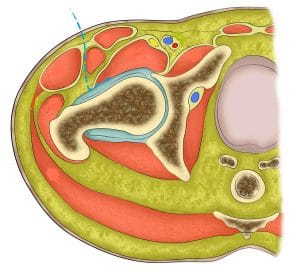 voie anterieure mini invasive